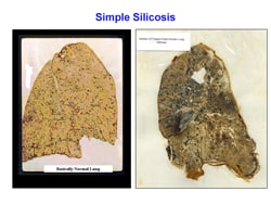 Example slide: normal lung versus lung with simple silicosis Example slide: normal lung versus lung with simple silicosis