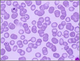 ORIGIN_img_MALARIA Highly magnified photo of Malaria