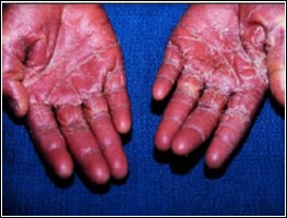 ORIGIN_img_TOXICSHOCK Photo of hands of a patient suffering from toxic shock.