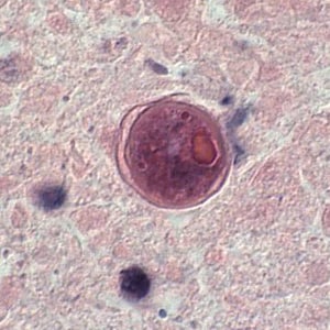 general-info-cysts2 Cyst of Balamuthia mandrillaris in brain tissue.