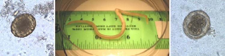ascariasis