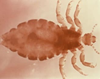 head lice