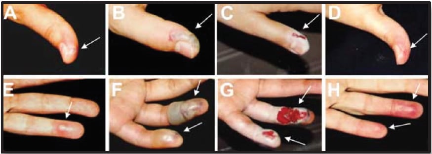 8 pregressive steps infection from needle stick