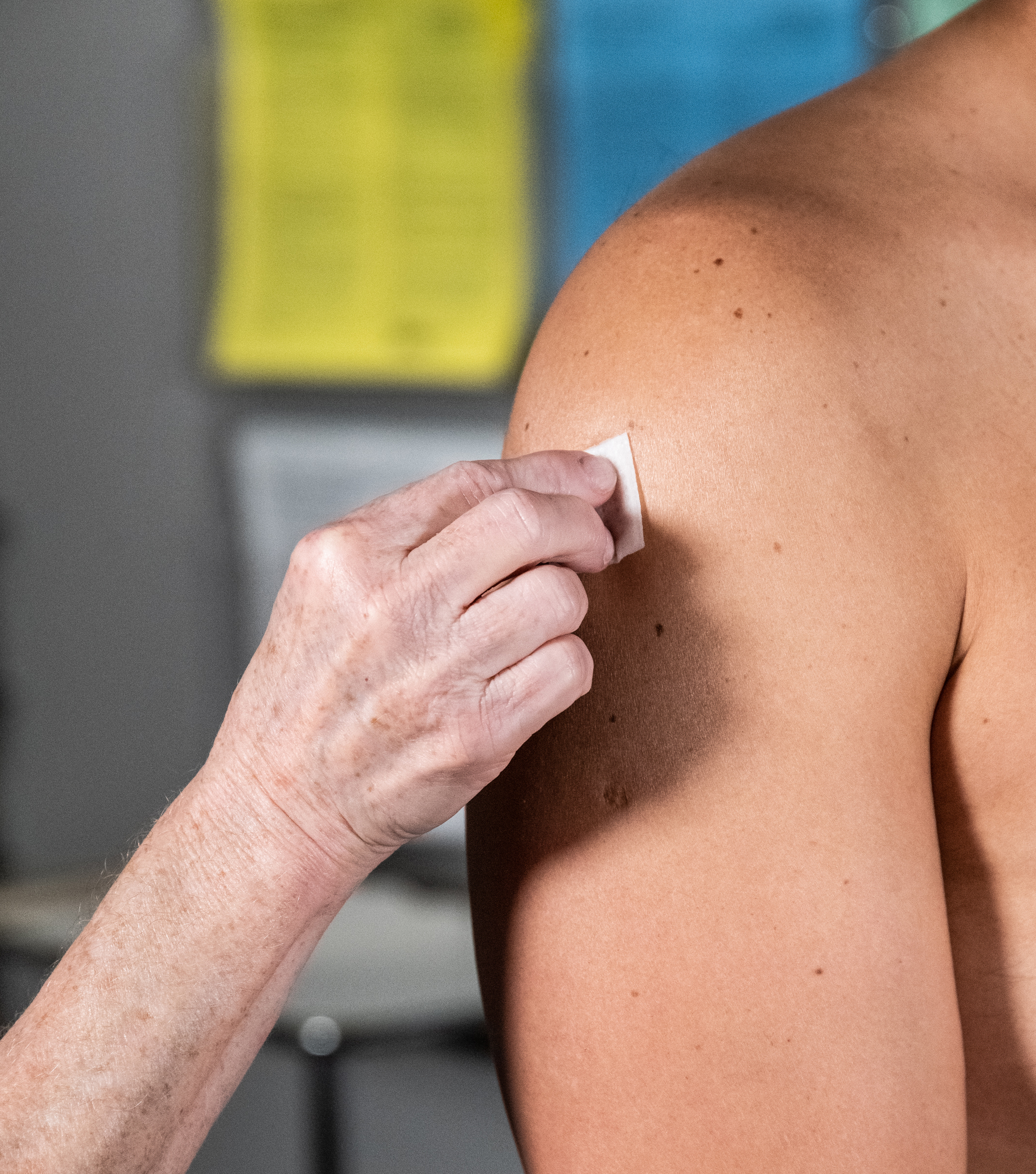 MPX_InjectionSites_2022_0051 Example of intradermal administration at the deltoid.
