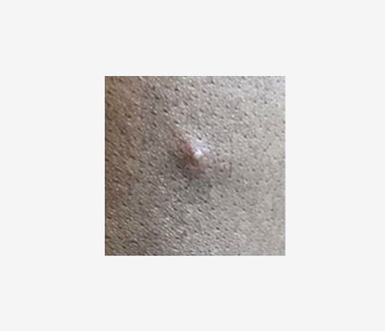 Photo of Monkey Pox rash