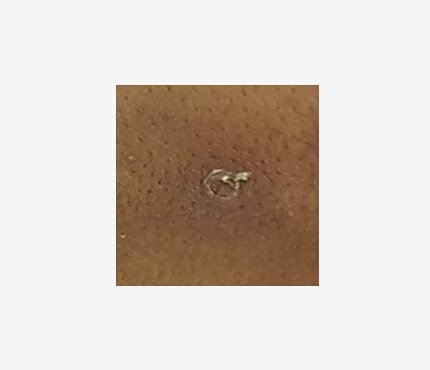 Photo of Monkey Pox rash