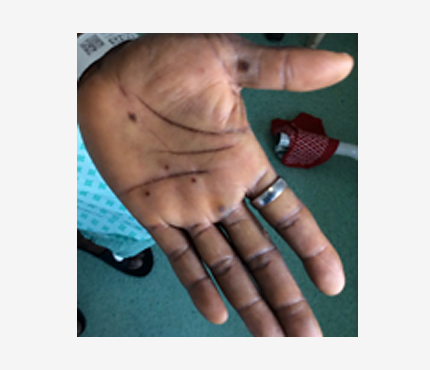 Photo of Monkey Pox rash