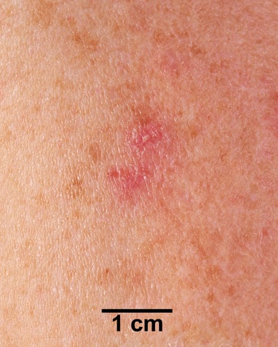 Vaccination site 14 days after vaccination in revaccinee.