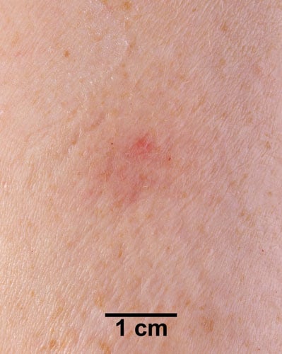 Vaccination site 7 days after vaccination in another revaccinee.