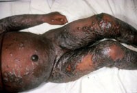 bt10.jpg Eczema vaccinatum on the arms, torso, and legs of a child.