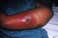 bt11.jpg Progressive vaccinia in patient with chronic granulocytic leukemia.