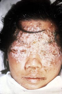 bt14.jpg Eczema vaccinatum in contact to recently vaccinated child.