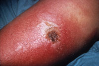 bt15.jpg Another view of progressive vaccinia lesion in patient with chronic granulocytic leukemia.
