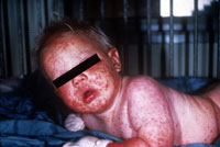 bt4.jpg Generalized vaccinia in child.