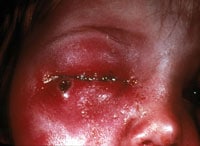 bt5.jpg Accidental auto-inoculation of eyelid with vaccinia virus with concurrent cellulitis.