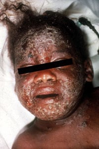 bt9.jpg Eczema vaccinatum on the face of a child.