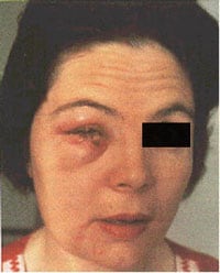 who_ai.jpg Woman with accidental auto-inoculation of lower eyelid with vaccinia virus.