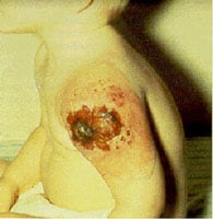 who_vn.jpg Fatal progressive vaccinia in a child with an immunodeficiency.