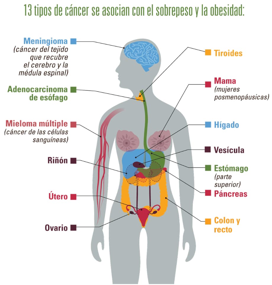 13 tipos de cáncer se asocian con el sobrepeso y la obesidad: meningioma (cáncer del tejido que recubre el cerebro y la médula espinal); adenocarcinoma de esófago Mieloma múltiple (cáncer de las células sanguíneas); riñón; útero; ovario; tiroides; mama (mujeres posmenopáusicas); hígado; vesícula; estómago (parte superior); páncreas; y colon y recto.