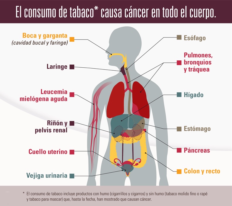 El consumo de tabaco causa cáncer en todo el cuerpo, incluyendo la boca y garganta (cavidad oral y faringe); laringe; esófago; pulmones, bronquios y tráquea; estómago; riñón y pelvis renal; páncreas; hígado; vejiga urinaria; cuello uterino; colon y recto; y leucemia mielógena aguda. El consumo de tabaco incluye productos con humo (cigarrillos y cigarros) y sin humo (tabaco molido fino o rapé y tabaco para mascar) que, hasta la fecha, han mostrado que causan cáncer.