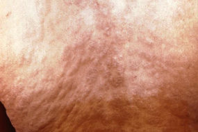 back-lesions-285 Secondary syphilis rash on the back.