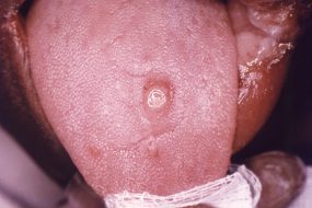 chancre-oral-1.jpg_542ae Primary stage syphilis sore (chancre) on the surface of a tongue.