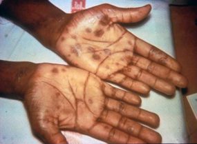palmar-1.jpg_535ed Secondary stage syphilis sores (lesions) on the palms of the hands. Referred to as palmar lesions.