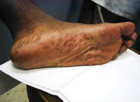 plantar-2.jpg_f1e6d Secondary stage syphilis sores (lesions) on the bottoms of the feet. Referred to as plantar lesions.