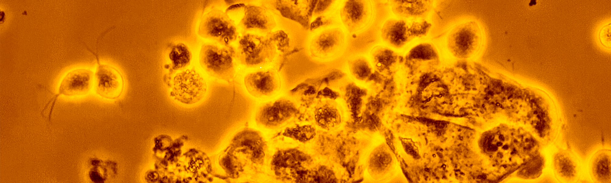 Trichomoniasis is common and easy to cure. trichomonas