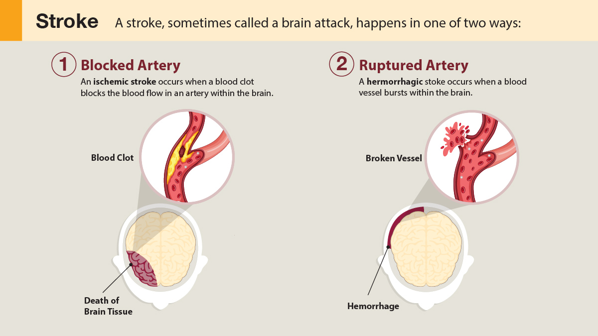 Stroke-Medical-Illustration A stroke happens in one of two ways: a blocked artery or a ruptured artery.