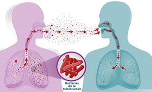 spanish-howTBspread How tuberculosis spreads