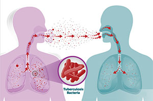 how-tb-spreads How tuberculosis spreads