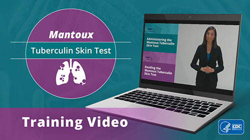 Mantoux_TB_SM_B Mantoux Skin Test