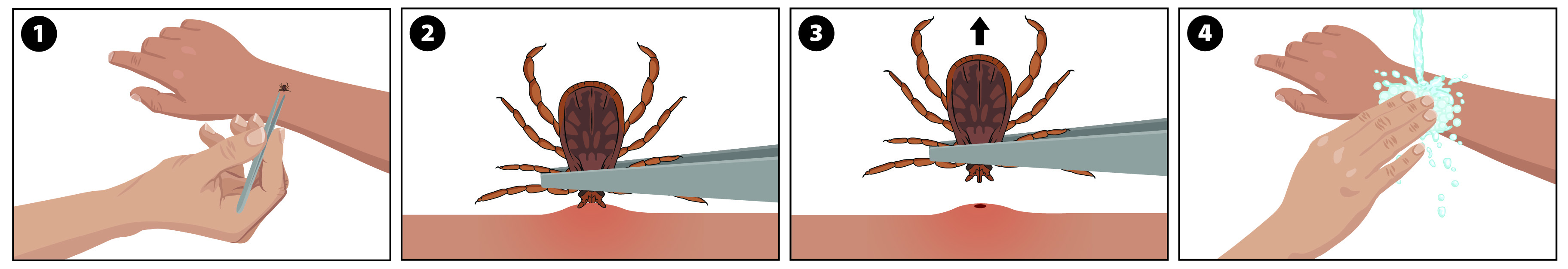 Illustration showing how to remove a tick (Ixodes scapularis pictured).