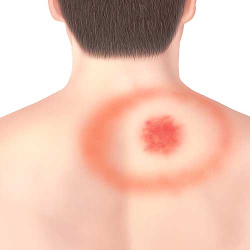 Medical illustration of symptoms
