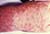 Person's hand showing Rocky Mountain spotted fever rash
