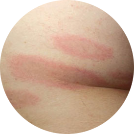 multiple red lesions with dusky centers