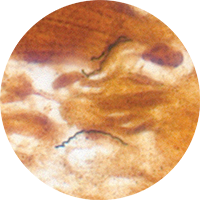 Lyme disease blood smear