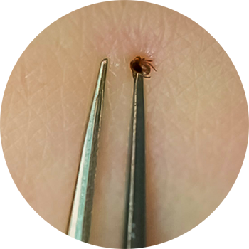 NYDOH_Grasping-tick Embedded tick being grasped by a pair of tweezers