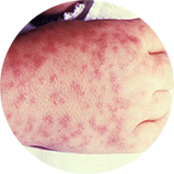 Child's right hand and wrist displaying the characteristic spotted rash of Rocky Mountain spotted fever