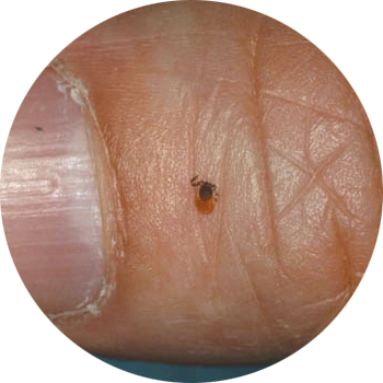 deertick_1_010728 Small embedded tick on persons thumb