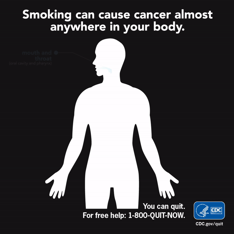 Smoking can cause cancer almost anywhere in your body Smoking can cause cancer almost anywhere in your body: Mouth and throat (oral cavity and pharynx); Esophagus, voice box (larynx); Lung, bronchus, and trachea; Acute myeloid leukemia; Liver; Kidney and renal pelvis; Stomach; Uterine cervix; Pancreas; Urinary bladder; Colon and rectum