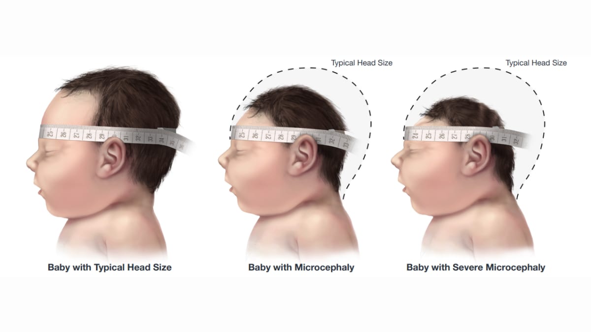 A baby with a typical size head, a baby with microcephaly, and a baby with severe microcephaly